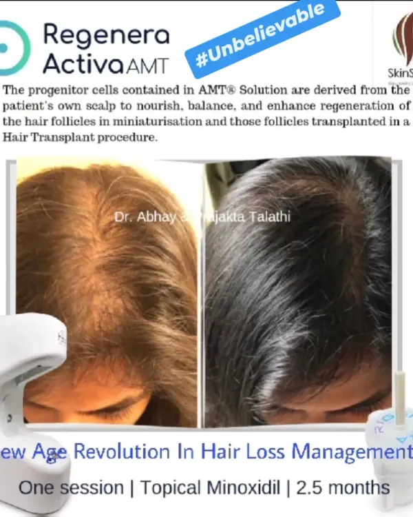This is the result of just one session of Regenera Activa combined with topical Minoxidil over 2.5 months. We focus on creating personalized hair restoration plans to achieve significant improvements in hair density and scalp health.