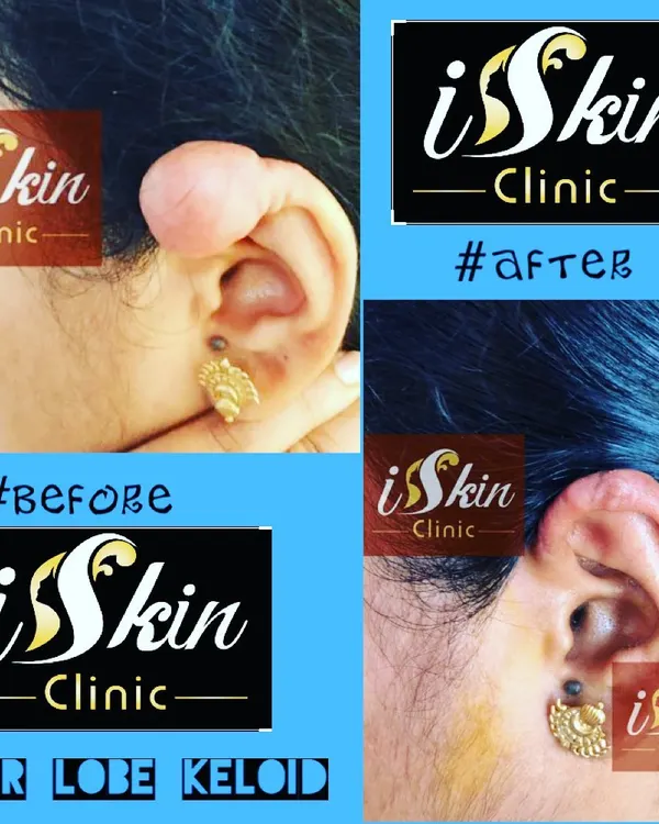 This before and after image displays the successful surgical removal of a large earlobe keloid. We carefully excised the overgrown scar tissue and reconstructed the earlobe to restore its natural shape, a common procedure we perform for patients post ear piercing.