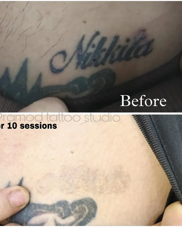 This before-and-after image shows the significant fading of a name tattoo after 10 sessions. My goal is to give you a clean slate, and this demonstrates the real, visible results of my professional laser removal process.