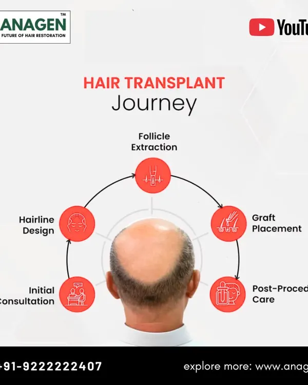 This infographic outlines the complete hair transplant journey. It starts with an initial consultation and hairline design, followed by follicle extraction, graft placement, and finally, post procedure care.