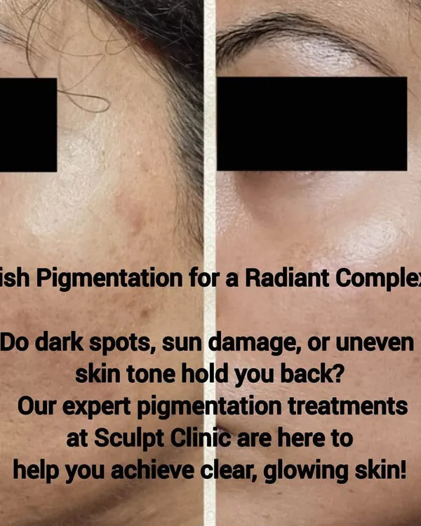This before-and-after image demonstrates the effectiveness of our pigmentation treatments. We help banish dark spots and sun damage, creating a more even and radiant complexion for our clients.