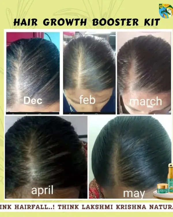 This before-and-after collage shows the real progress a customer made using our Hair Growth Booster Kit over several months. You can see the gradual but significant improvement in hair density from December to May.