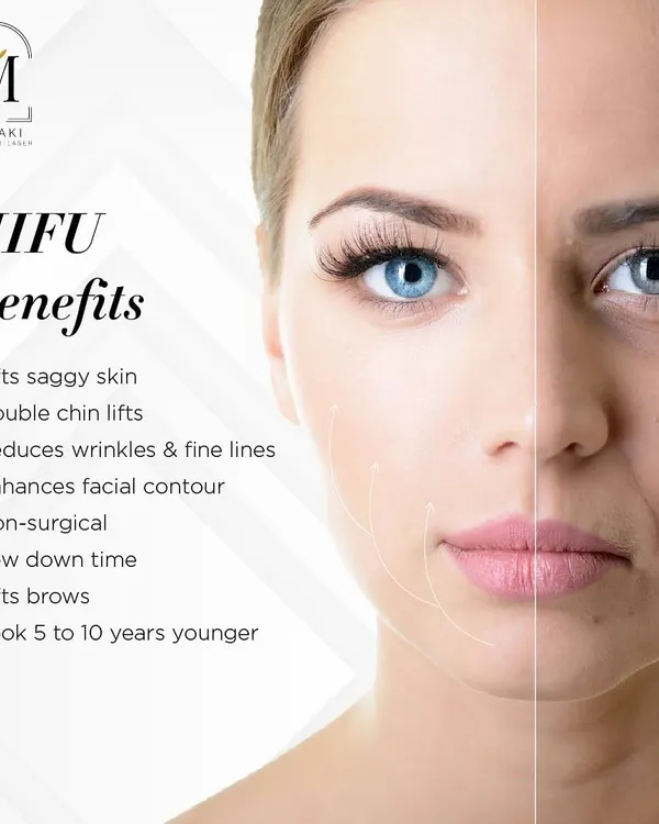This visual clearly shows the transformative power of HIFU. It is a non-surgical way to lift saggy skin, reduce a double chin, and smooth fine lines, helping you look years younger with very low downtime.
