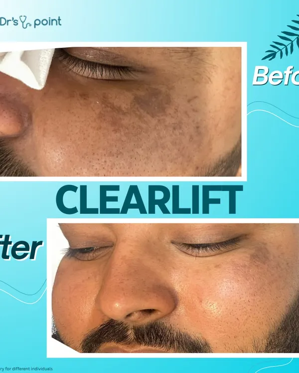 A clear before-and-after look at the results of our ClearLift treatment. This non-ablative laser is excellent for tackling skin imperfections like pigmentation and fine lines, revealing smoother, more youthful skin without downtime.