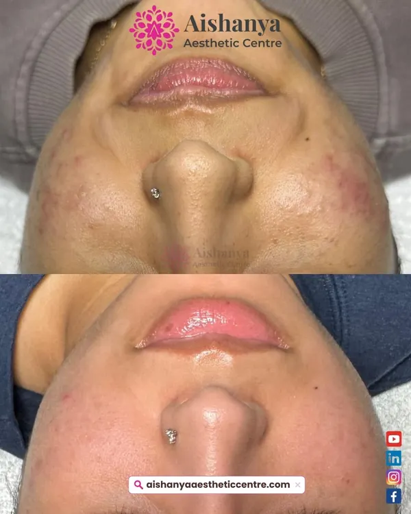 This client was struggling with skin congestion and inflammation. With a consistent, customized treatment plan, we were able to significantly calm her skin, reduce breakouts, and improve the overall texture for this amazing, smooth result.