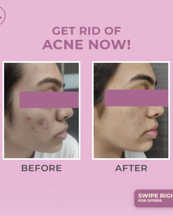 (Hero Item) This is the power of a personalized treatment plan. We addressed this client's active acne and post-inflammatory marks with a combination of targeted therapies, revealing clearer, healthier skin and restoring their confidence.