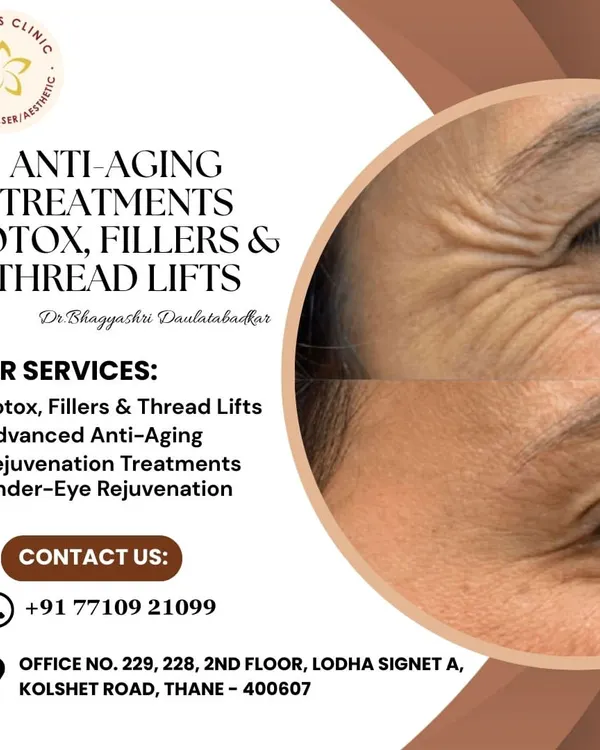 This graphic provides an overview of my primary anti-aging services: Botox, fillers, and thread lifts. This before-and-after of crow's feet shows how injectables can soften expression lines for a rested, youthful look.