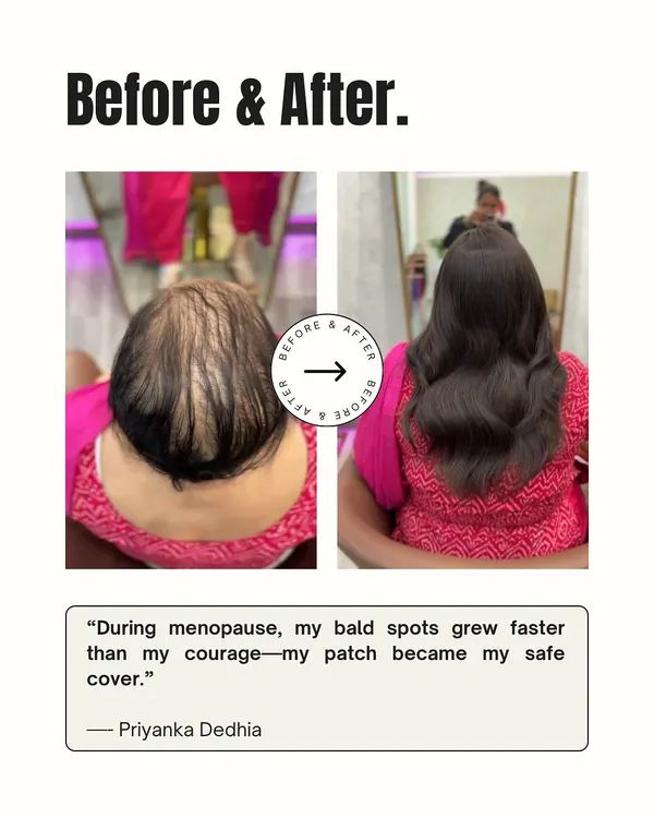 Menopause can bring unexpected changes like rapid hair thinning. For Priyanka, this hair patch became her safe cover, allowing her to face the world with renewed confidence.