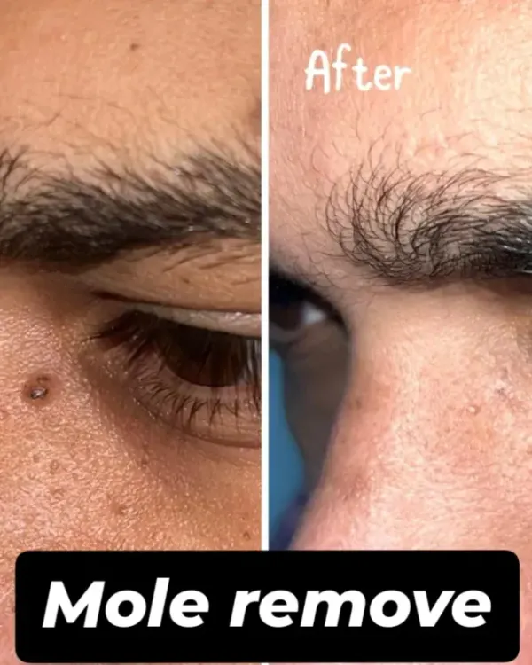 This is a clear demonstration of our safe and precise mole removal procedure. We help you achieve smooth, blemish-free skin with minimal downtime, boosting your confidence.