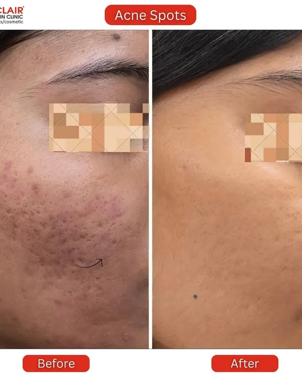 A clear view of a significant reduction in both active acne spots and textured scarring. Our goal is to not only clear current breakouts but also to repair the underlying skin texture for a truly smooth finish.