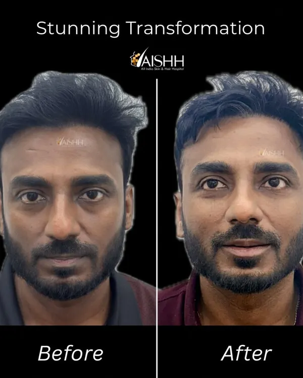 This is a great example of a full-face rejuvenation. We addressed concerns like a tired look from under-eye bags, flat cheeks, and thin lips using a few milliliters of hyaluronic acid filler to restore volume and structure for a refreshed, confident appearance.