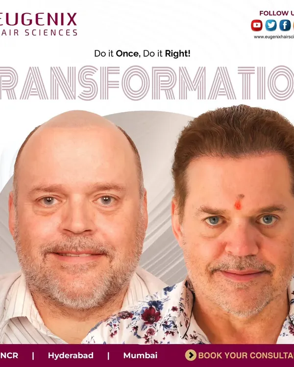 This is the kind of complete transformation that is possible with our advanced Direct Hair Transplantation technique. We focus on creating a natural, dense look that restores not just hair, but also youthfulness and confidence.