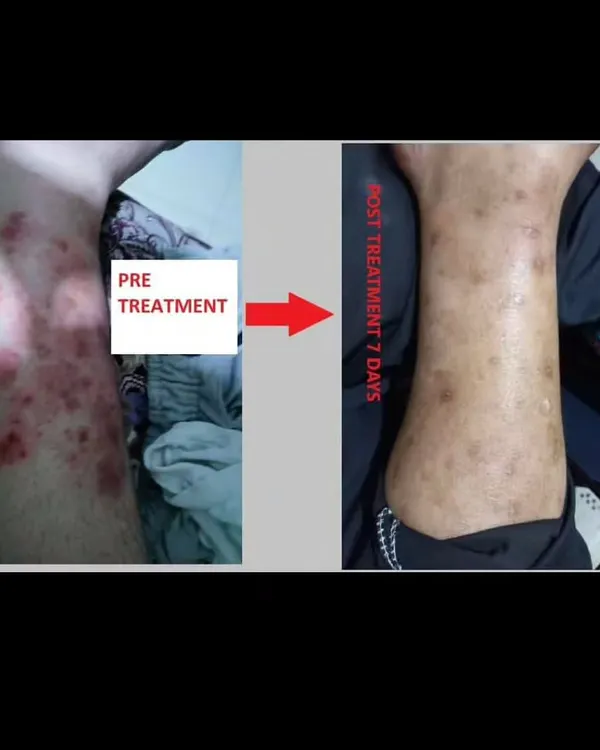This is a clear example of progress after just seven days of my Ayurvedic treatment. The image shows a significant reduction in inflammation and lesions on the patient's leg, demonstrating how quickly the body can begin to heal with the right approach.