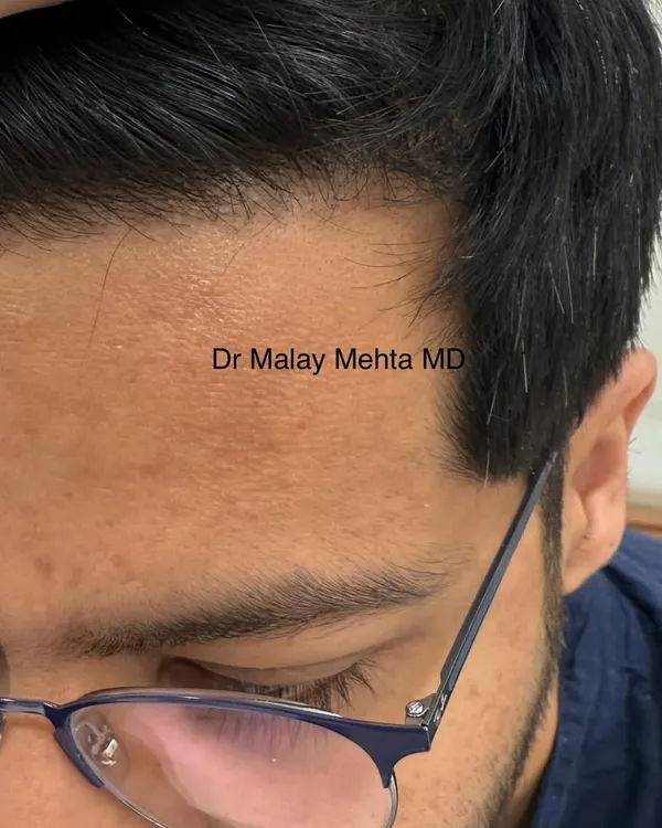 Here you can see a restored hairline that blends flawlessly with the patient's existing hair. The use of single follicular units at the very front and an irregular placement pattern are key to achieving this undetectable result.