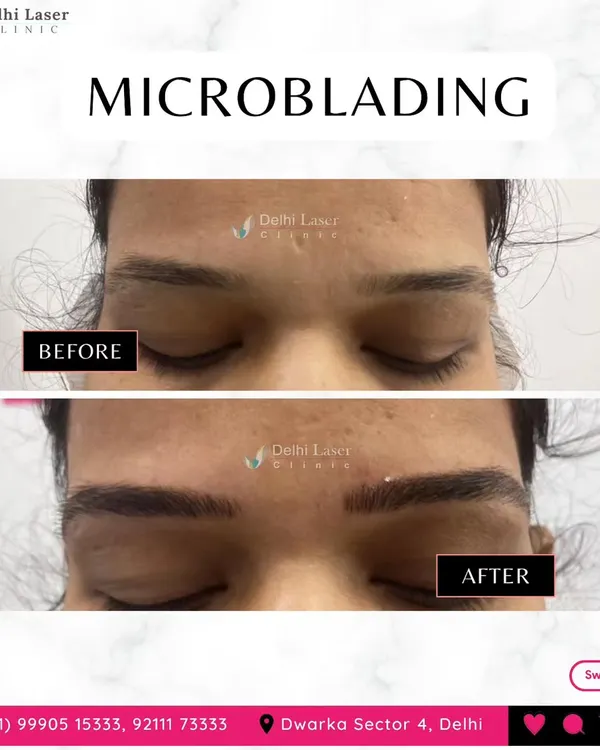 This before-and-after image is a clear example of a microblading transformation. We took sparse, undefined brows and created a fuller, perfectly arched shape that looks completely natural and enhances the eyes.