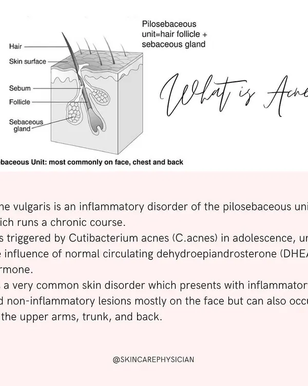 To effectively treat acne, we first need to understand what it is. This visual explains the pilosebaceous unit, the part of your skin where acne, an inflammatory disorder, begins.
