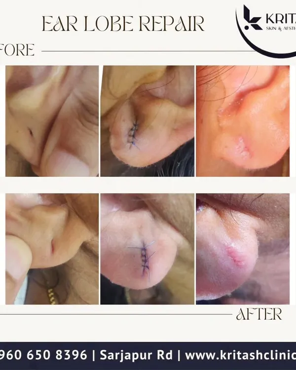 This before and after collage shows the complete journey of an earlobe repair. You can see the initial tear, the precise sutures immediately after the procedure, and the clean, healed result. It's a quick and effective in-clinic treatment I perform for split earlobes, often caused by heavy earrings or accidents.