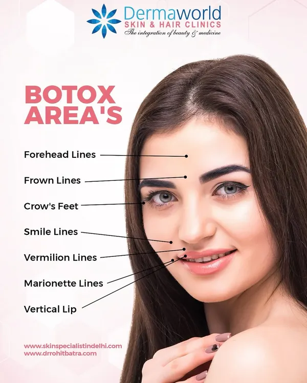 This diagram shows the specific areas where Botox can be most effective. I precisely target muscles that cause forehead lines, crow's feet, and smile lines to create a smoother and more youthful appearance without affecting your natural expressions.