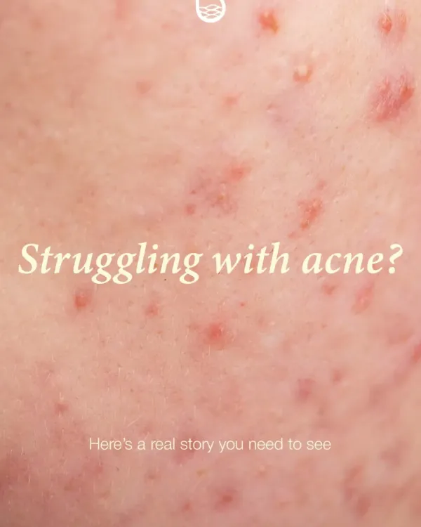 If you are struggling with acne, it is important to seek professional guidance. A real diagnosis and tailored plan are the first steps toward clear skin.