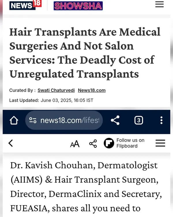 A screenshot of my interview with News18, where I emphasized that hair transplants are serious medical surgeries, not simple salon services, and stressed the importance of choosing a qualified surgeon.