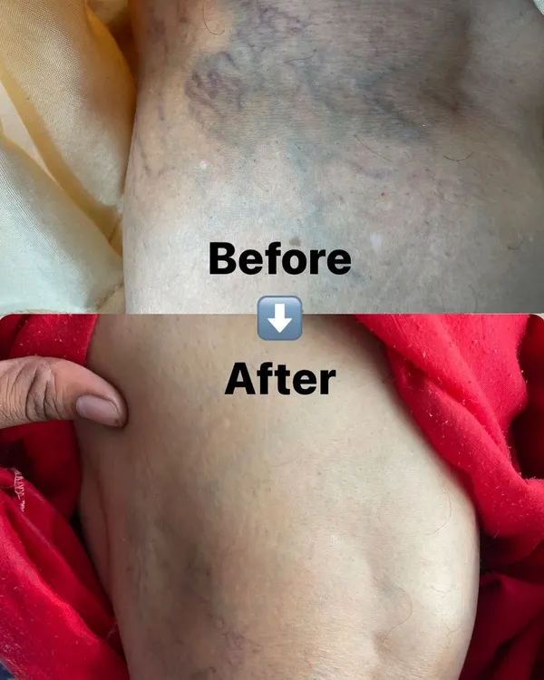 This before and after comparison shows the significant improvement in varicose veins for a 60-year-old client. We focus on treatments that not only reduce visible symptoms but also alleviate the associated discomfort and improve circulation.