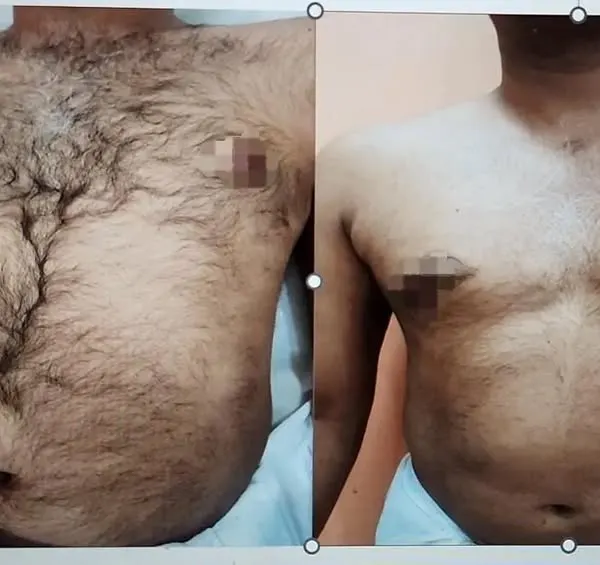 A clear before-and-after comparison of male chest hair reduction. These results were achieved after just 4-5 sessions, demonstrating the effectiveness of the treatment.