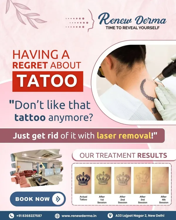 This chart explains the tattoo fading process. We'll create a personalized plan for you, but this gives you an idea of how the ink lightens with each laser session, typically spaced weeks apart to allow for healing.