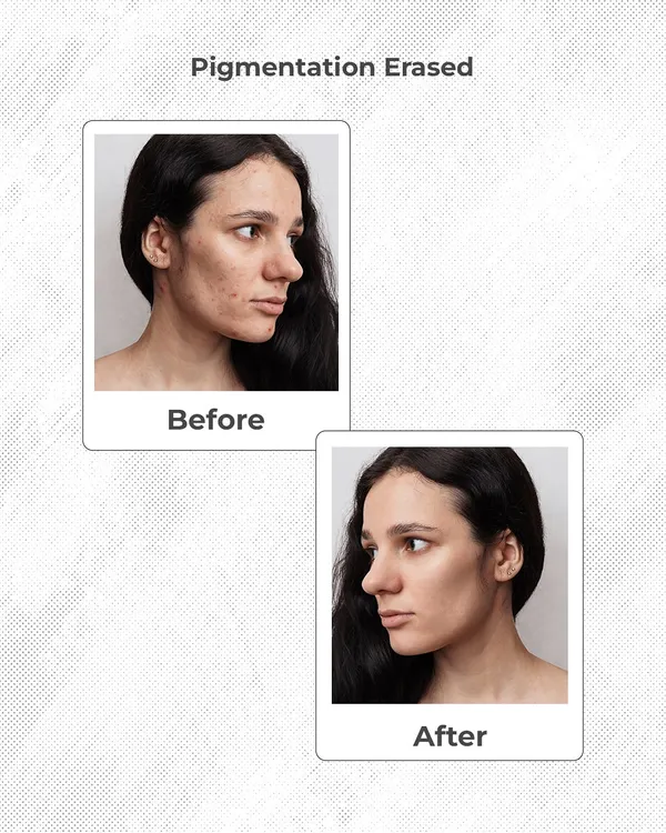 This before and after result shows a significant reduction in facial pigmentation. My approach targets the overproduction of melanin to erase dark spots and even out skin tone for a clearer complexion.