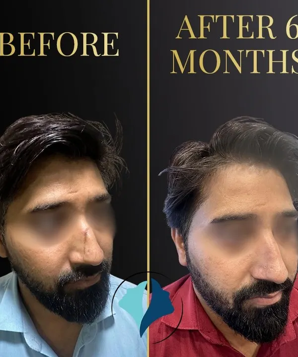 This patient came to me with a prominent scar on his nose from a previous injury. Through a surgical scar revision procedure, we were able to significantly reduce its visibility. This photo shows the result after six months of healing, demonstrating a much smoother and more natural appearance.