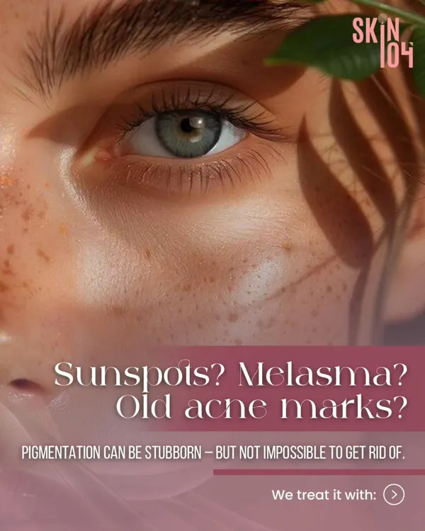 Are you dealing with sunspots, melasma, or old acne marks? Pigmentation can be stubborn, but it's not impossible to treat. We offer advanced solutions to get rid of uneven skin tone for good.