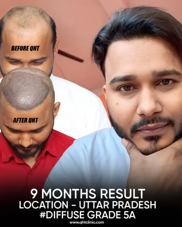 A fantastic 9-month result for a patient from Uttar Pradesh with Diffuse Grade 5A hair loss. The image collage displays the 'before' state, the scalp immediately 'after' the 5000-graft procedure, and the impressive final outcome.