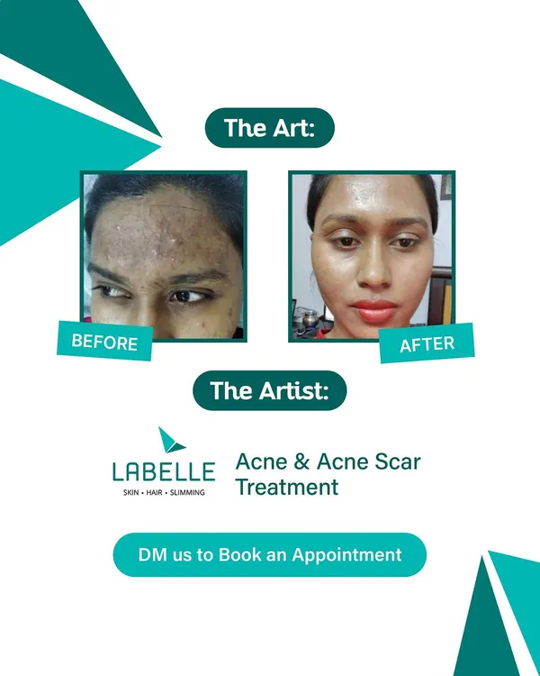 We see your skin as a canvas and our treatments as the art. This client's journey shows a significant reduction in acne and scarring, resulting in a masterpiece of clear, smooth skin.