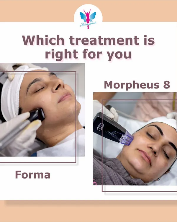 Forma or Morpheus8? Forma is ideal for mild to moderate skin laxity and a quick pre-event glow, while Morpheus8 goes deeper to treat fine lines, wrinkles, and acne scarring.
