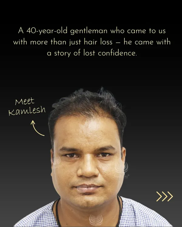 Meet Kamlesh, who came to us with thinning hair and lost confidence. This before-and-after shows his incredible transformation with our I-Hair Restoration protocol, proving it's never too late to feel like yourself again.