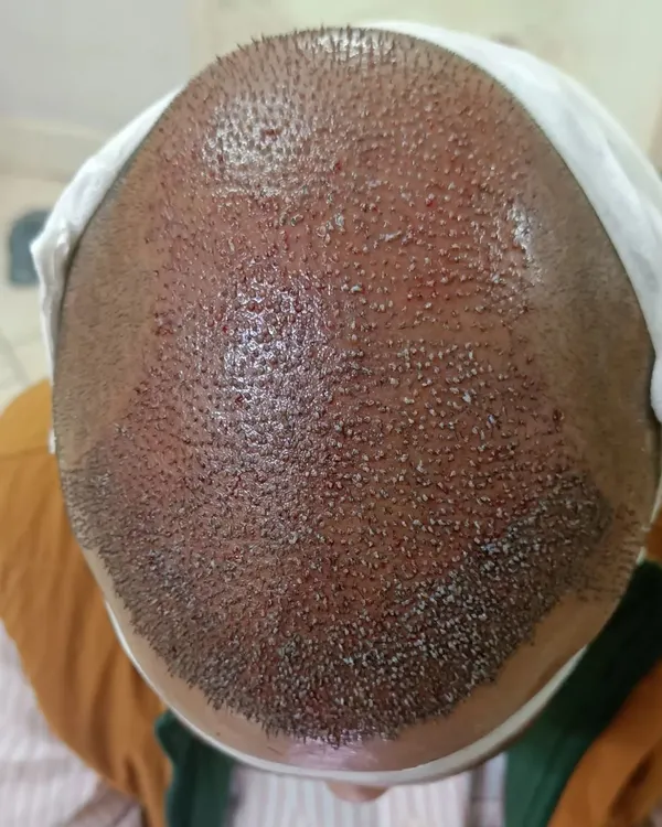 This is the immediate result after a 10,000-graft hair transplant. You can see the density and the precision of the placement, which is key to achieving a full, natural look once the hair grows in.