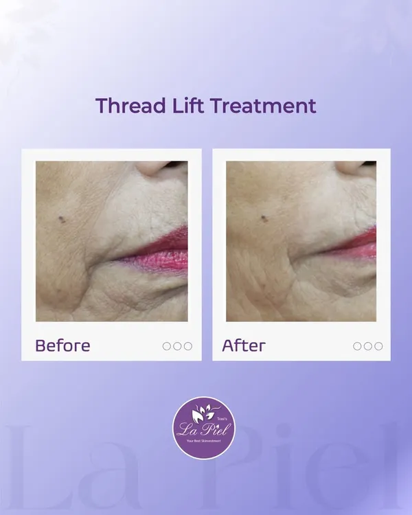 This before-and-after of a Thread Lift treatment shows how we can achieve a subtle yet significant lift. Notice the improved definition along the jawline and the softening of folds around the mouth, resulting in a naturally refreshed and more youthful contour.