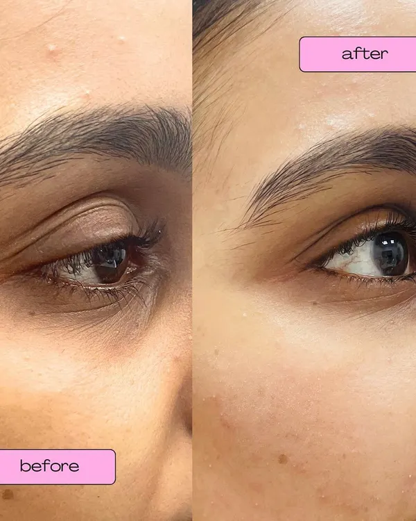 A clear example of how under-eye fillers can make a significant difference. We used just 0.4ml of hyaluronic acid filler under each eye to correct hollowness and reduce the appearance of dark circles, resulting in a naturally refreshed look.