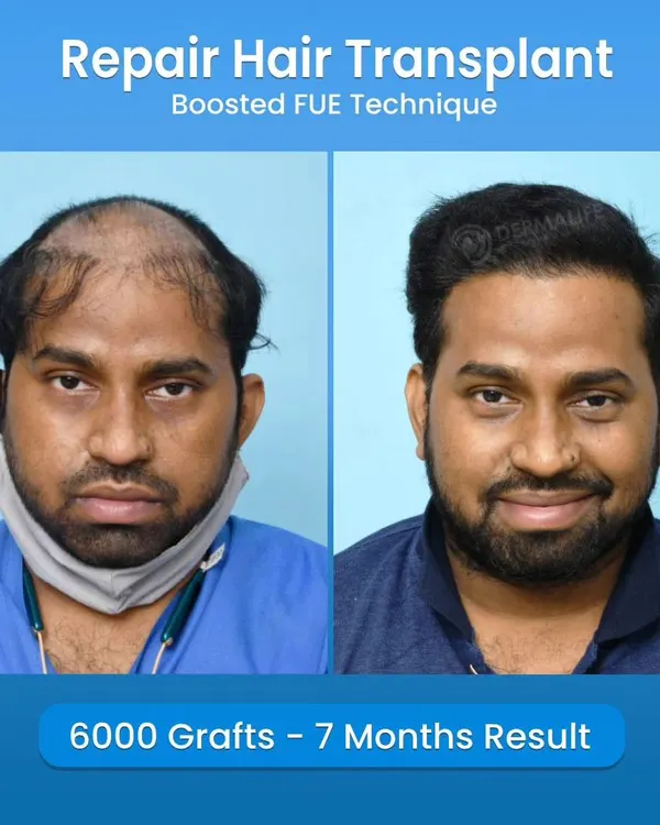This is a 7-month result of a repair hair transplant. We implanted 6000 grafts using the Boosted FUE technique to correct a previous procedure, achieving a full and natural-looking hairline.