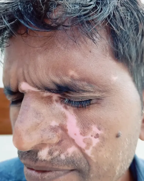 This patient has Vitiligo patches on the face, an area that can cause a lot of stress. My treatment focuses on carefully restoring pigment to these visible areas.
