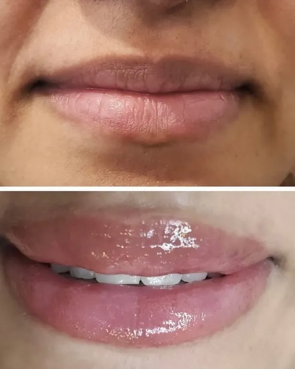 This before-and-after showcases a complete lip transformation. I neutralized the initial uneven pigmentation and cool tones, then applied a vibrant, healthy pink blush. The result is fuller, more defined lips with a glossy finish that looks fresh and youthful, eliminating the daily need for lipstick.