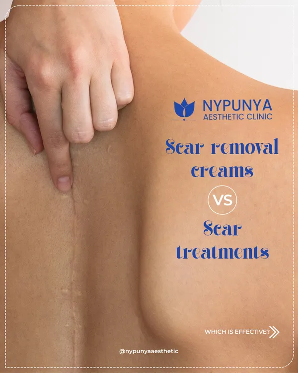 A question I get all the time is whether scar removal creams are as effective as in-clinic scar treatments. The answer depends on the type and depth of your scar.