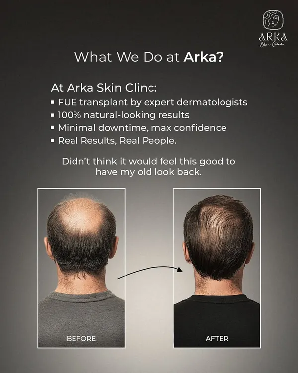 This is the kind of transformation that restores confidence. We achieved this full, natural-looking coverage using our advanced FUE hair transplant technique. The goal is always to create a result so seamless that it looks like you never lost any hair in the first place.
