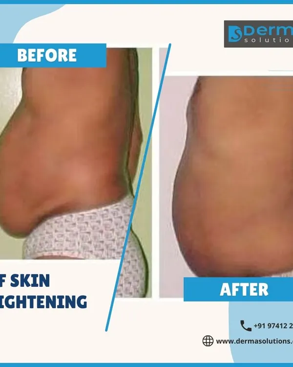 This before and after image shows the tangible results of my RF Skin Tightening treatment. You can see a significant reduction in abdominal skin laxity and a firmer, more toned appearance. This is achieved by using radiofrequency energy to stimulate your body's natural collagen production.