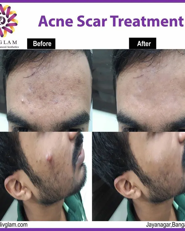 Our advanced acne scar treatment delivers visible results, smoothing skin texture and restoring confidence. This before-and-after showcases a significant reduction in acne scarring and improved overall skin clarity for one of our male clients.
