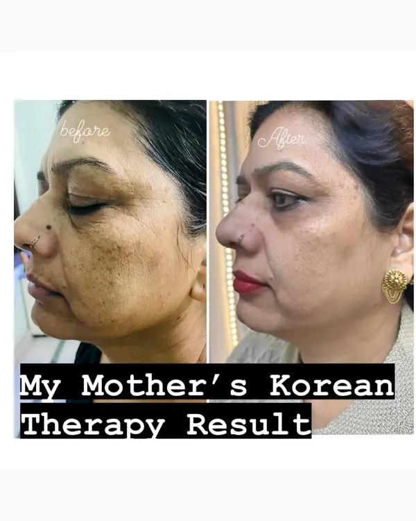 This is the result of my mother's Korean Skin Therapy. I only use treatments that I trust for my own family, and this photo shows the safe, incredible transformation possible, targeting deep pigmentation and signs of aging for a clearer, youthful look.