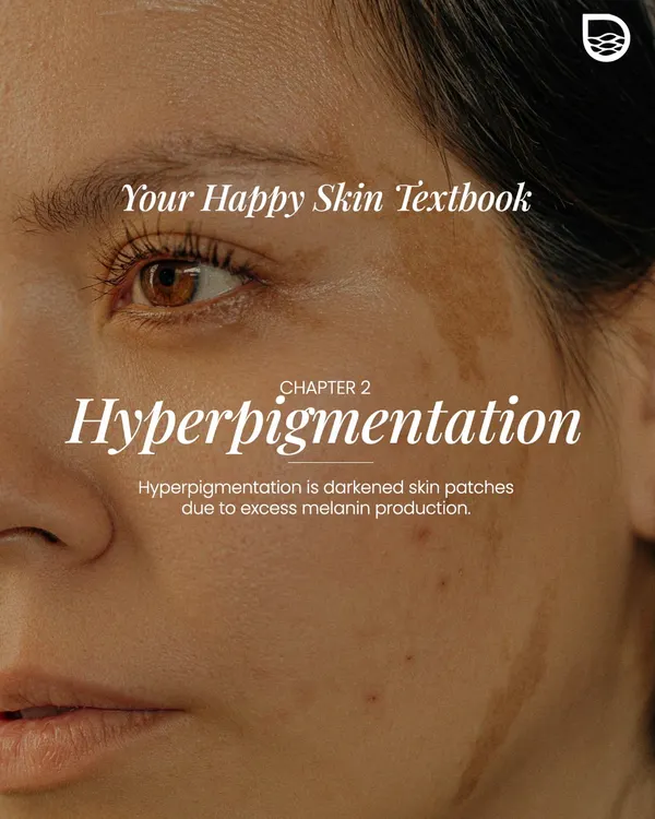 Welcome to your happy skin textbook. In this chapter, we delve into hyperpigmentation, which is the darkening of skin in patches due to excess melanin production.