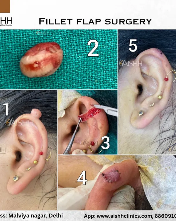 This collage shows the key steps of an earlobe keloid removal using a fillet flap surgery technique. This method allows for complete removal of the keloid tissue with a very low chance of recurrence.