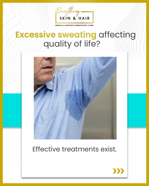 Excessive underarm sweating, as shown in this image, is a primary symptom of hyperhidrosis. It's a medical condition for which effective, evidence-based treatments exist to restore comfort and confidence.