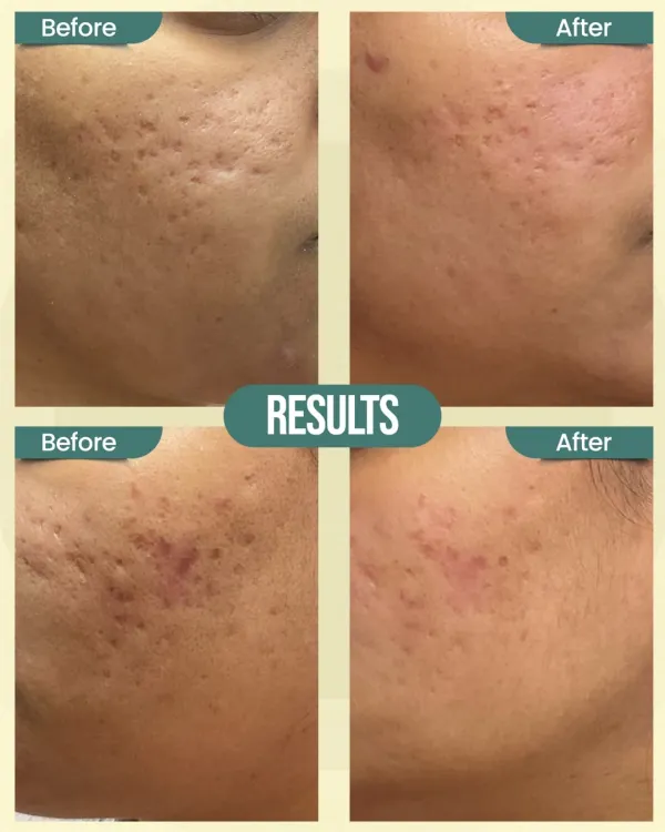These before-and-after photos showcase the significant improvement in deep acne scars after a course of advanced treatments. By combining therapies like Subcision with RF and Exosome Therapy, we can release tethered scars and rebuild collagen for a smoother skin surface.