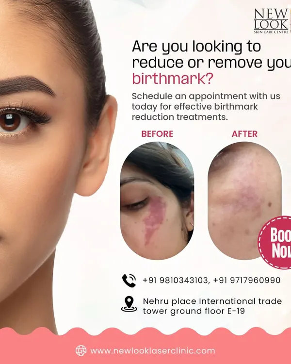 This before and after image shows the significant reduction of a vascular birthmark. Our treatments are designed to progressively lighten such marks over a series of sessions, leading to clearer skin and renewed confidence.